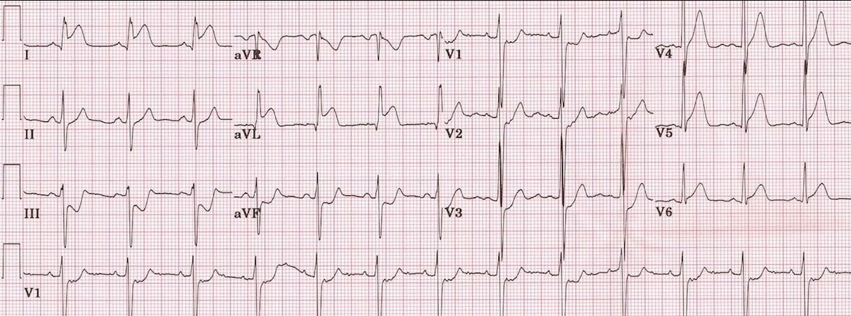 ЭКГ бокового инфаркта миокарда