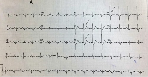 ЭКГ заднего инфаркта миокарда