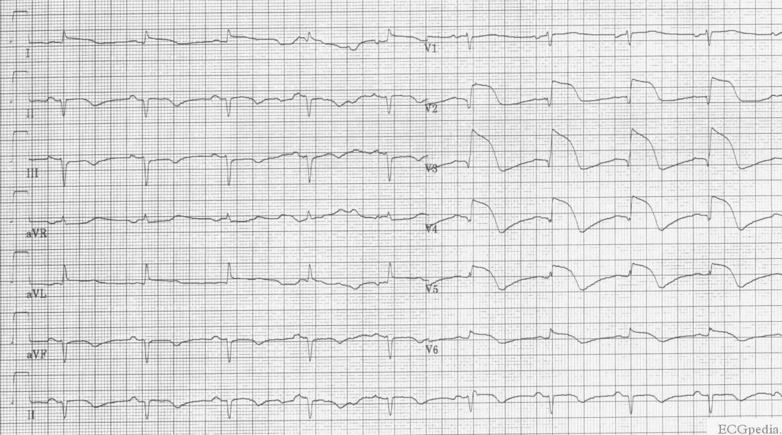 ЭКГ переднего инфаркта миокарда