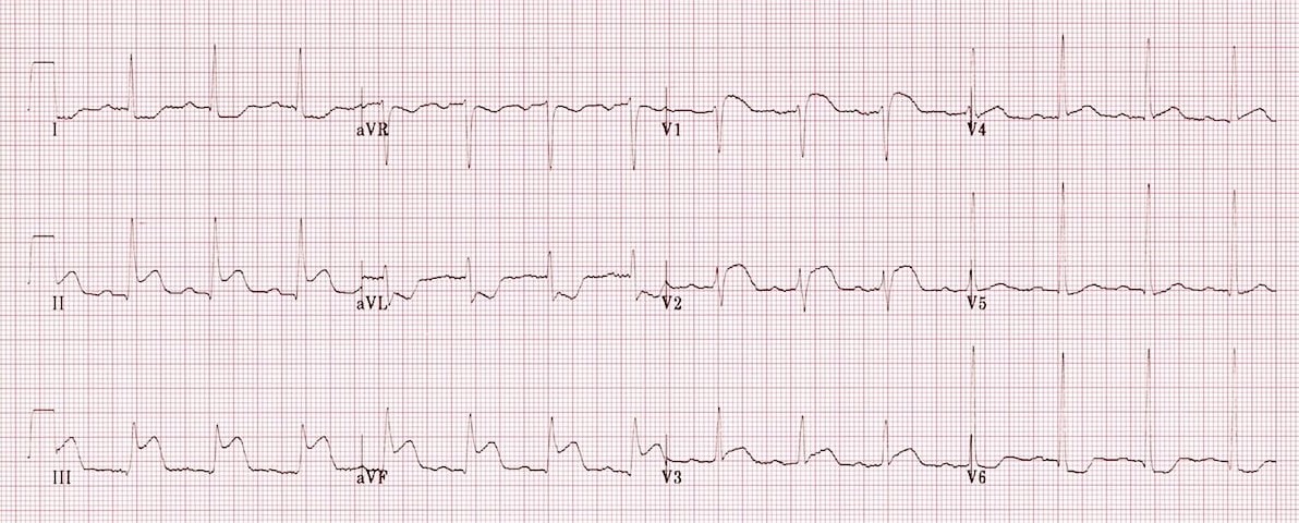 ЭКГ инфаркта правого желудочка
