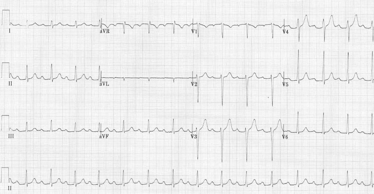 ЭКГ АВ-блокады I степени