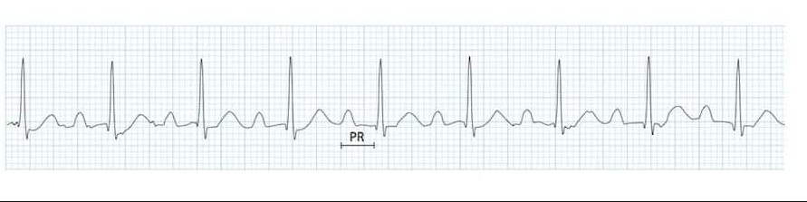ЭКГ АВ-блокады I степени