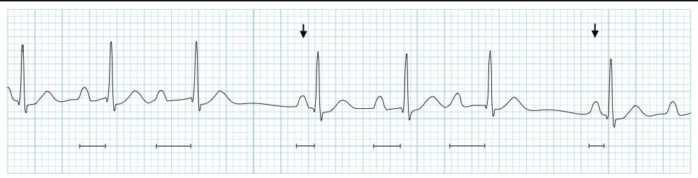 ЭКГ АВ-блокады II степени Мобитц I