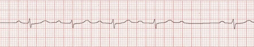 ЭКГ АВ-блокады II степени Мобитц I