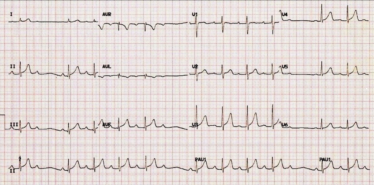 ЭКГ АВ-блокады II степени Мобитц I