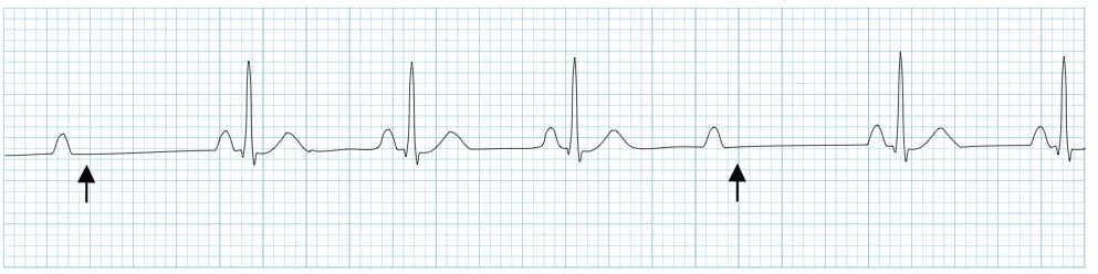 ЭКГ АВ-блокады II степени Мобитц II