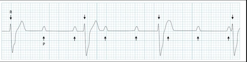АВ-блокада III степени