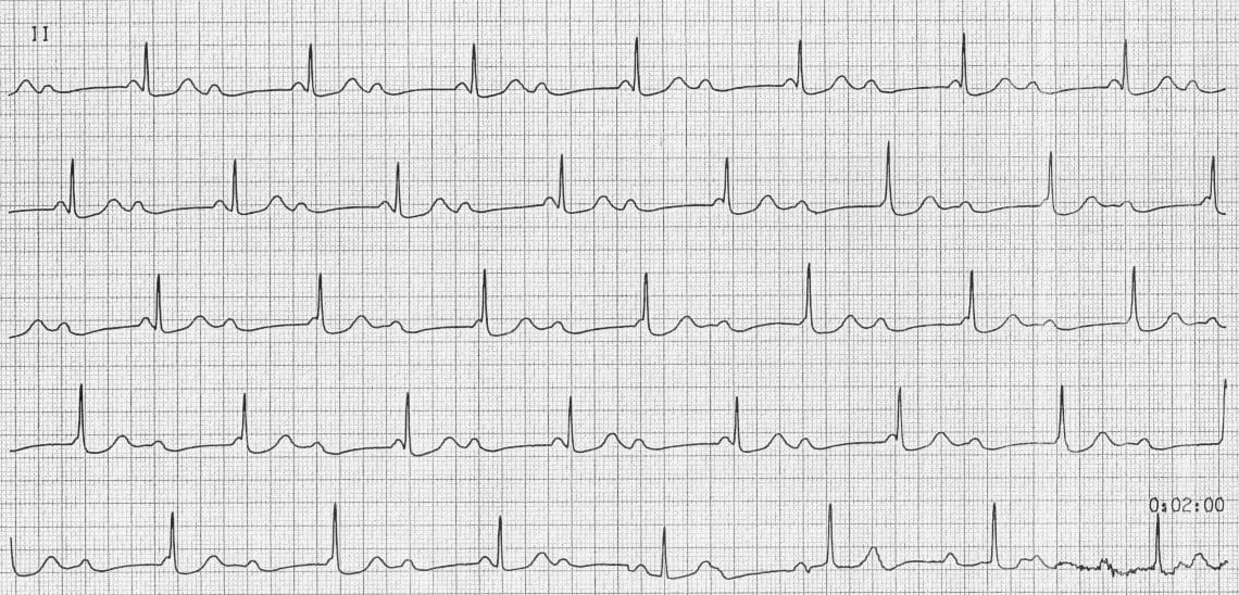 ЭКГ АВ-блокады III степени