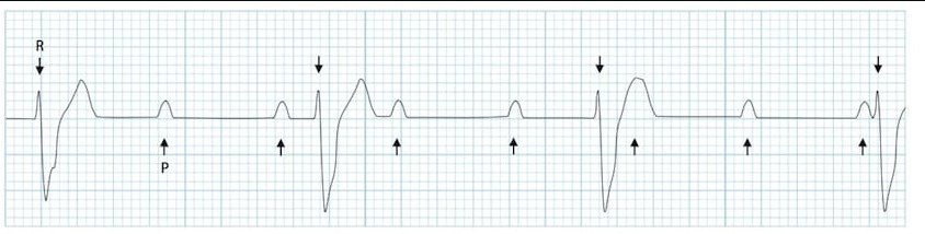 ЭКГ АВ-блокады III степени