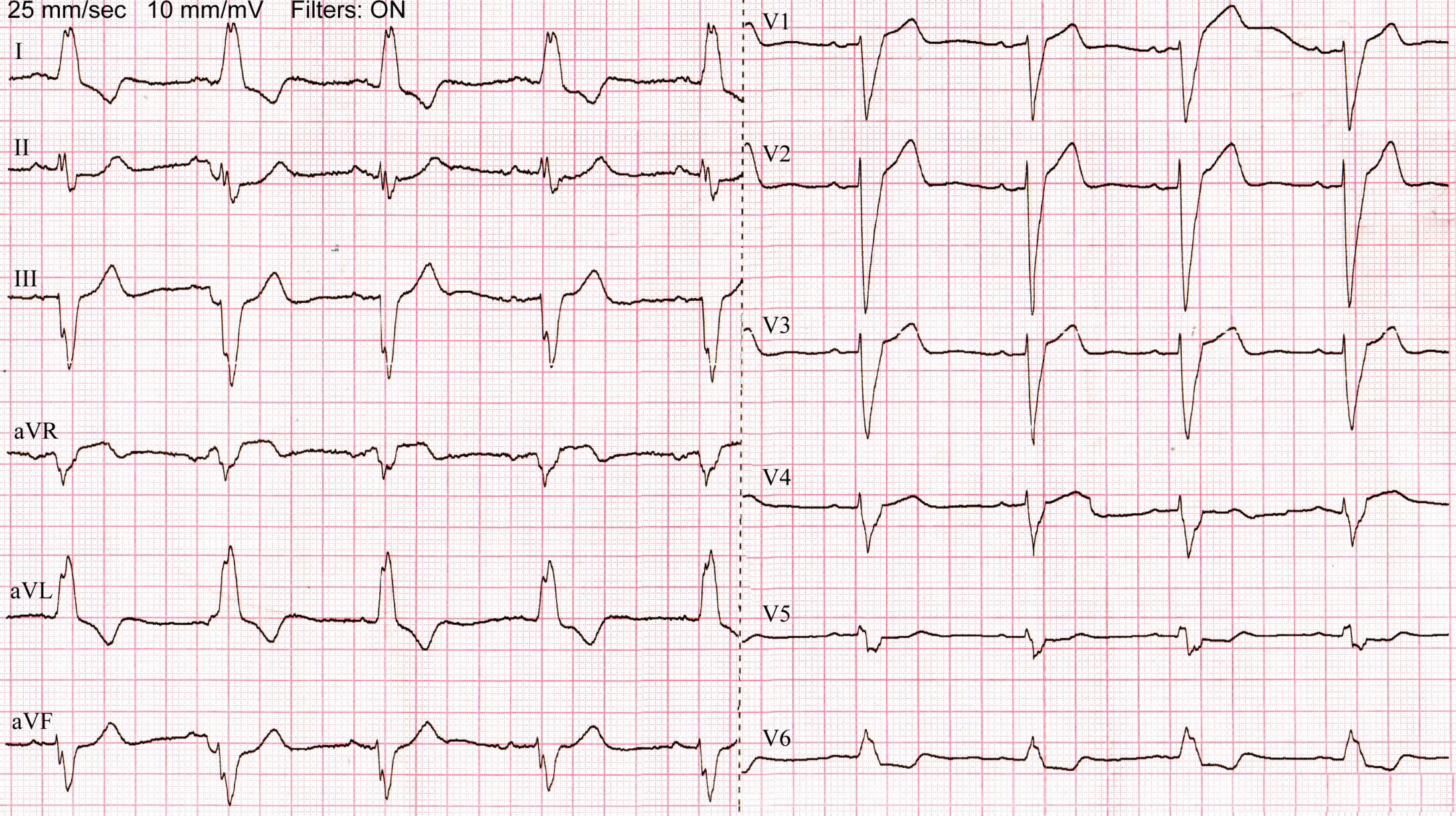 ЭКГ полной левой блокады ножки пучка Гиса