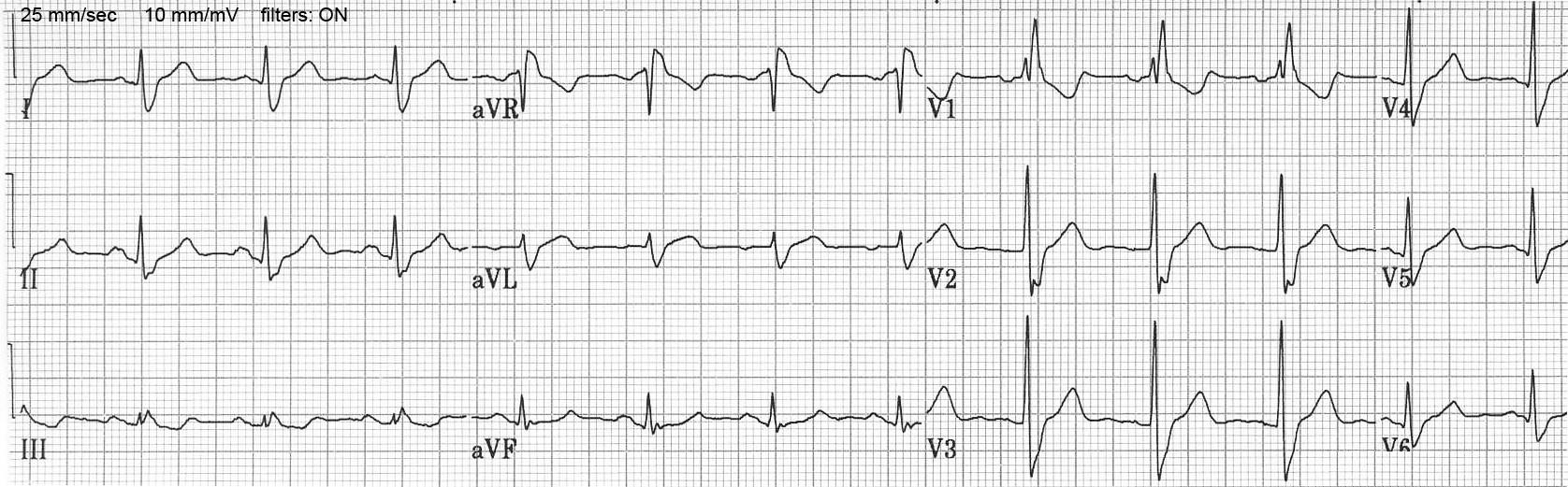 ЭКГ правой блокады ножки пучка Гиса