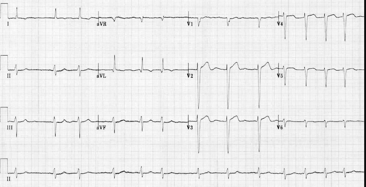 Фибрилляция предсердий