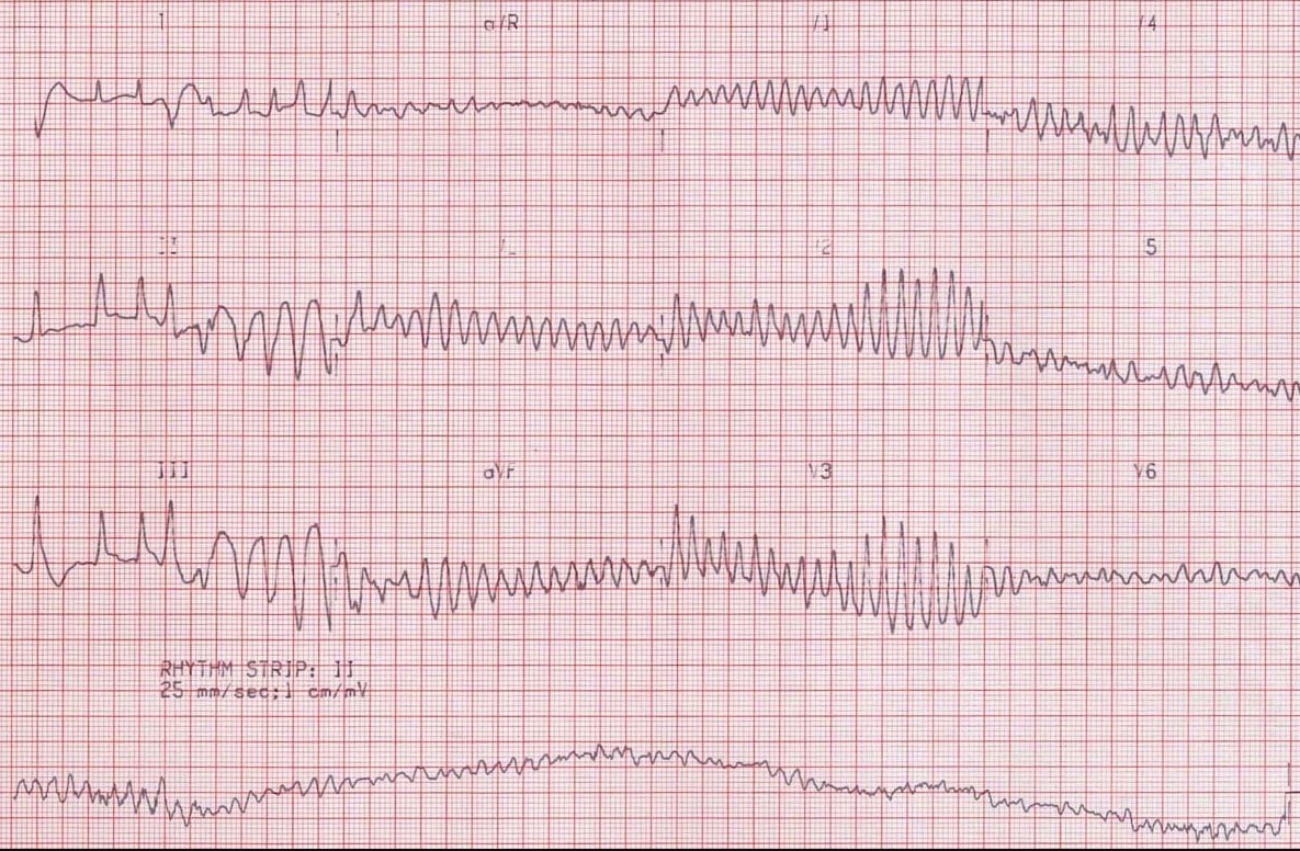 ЭКГ фибрилляции желудочков