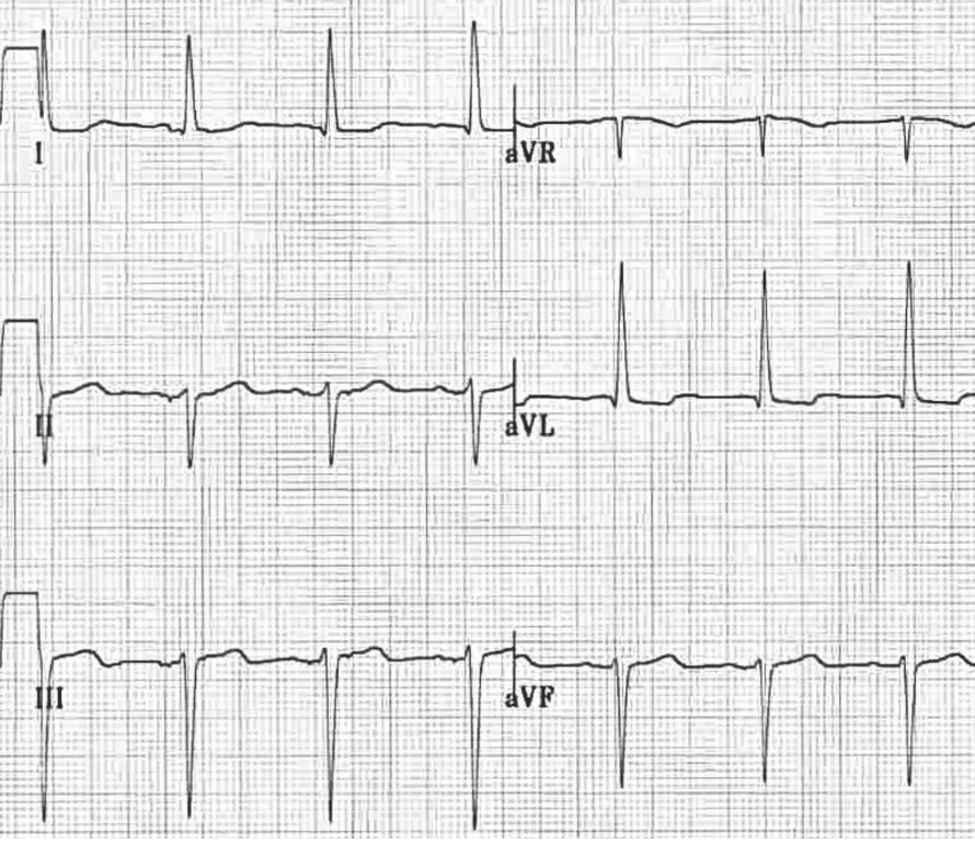 ЭКГ блокады передней ветви левой ножки пучка Гиса
