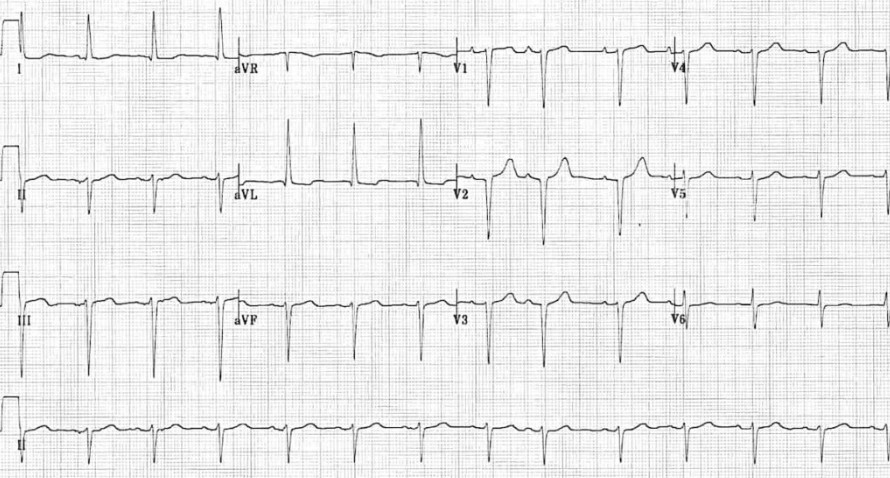 ЭКГ блокады передней ветви левой ножки пучка Гиса