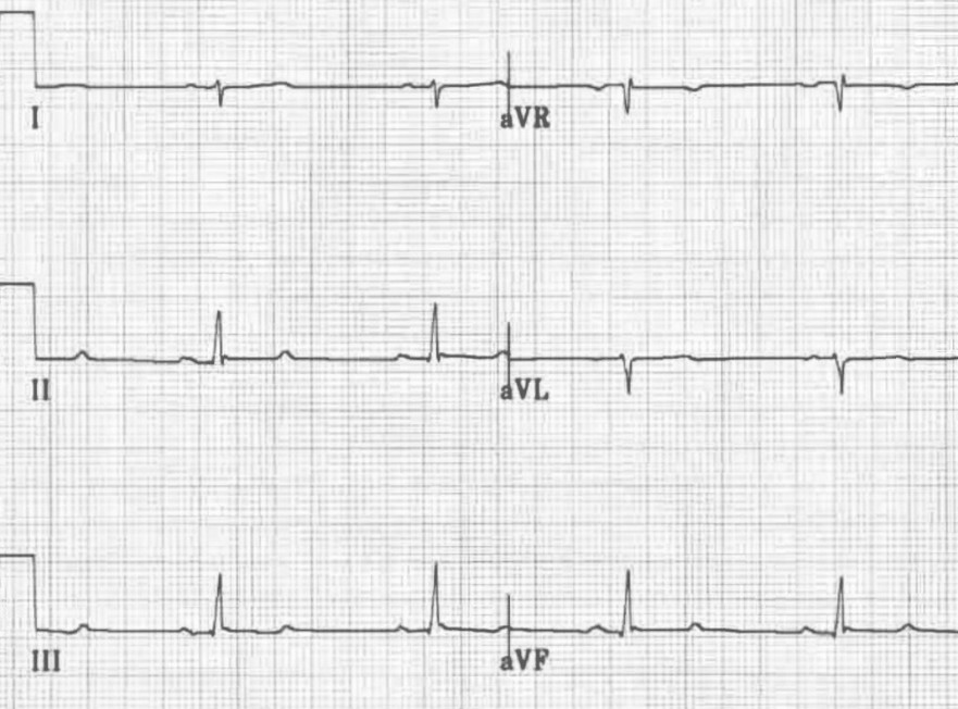 ЭКГ блокады задней ветви левой ножки пучка Гиса