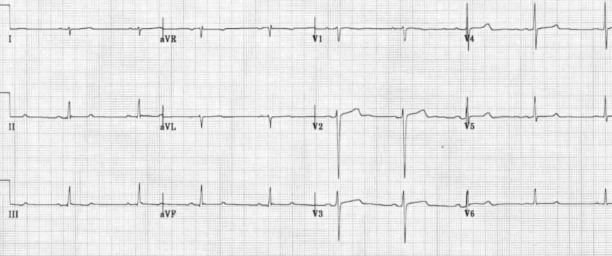 ЭКГ блокады задней ветви левой ножки пучка Гиса