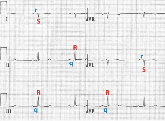 ЭКГ блокады задней ветви левой ножки пучка Гиса