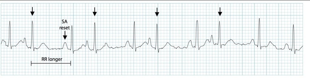 ЭКГ предсердной экстрасистолии