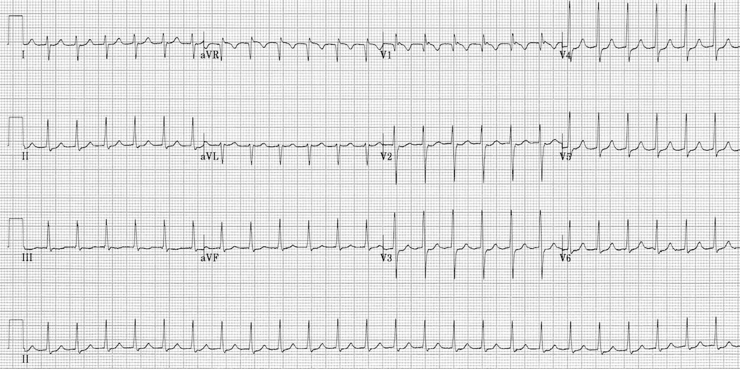 ЭКГ пароксизмальной наджелудочковой тахикардии