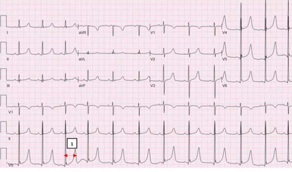 ЭКГ удлинения интервала QT