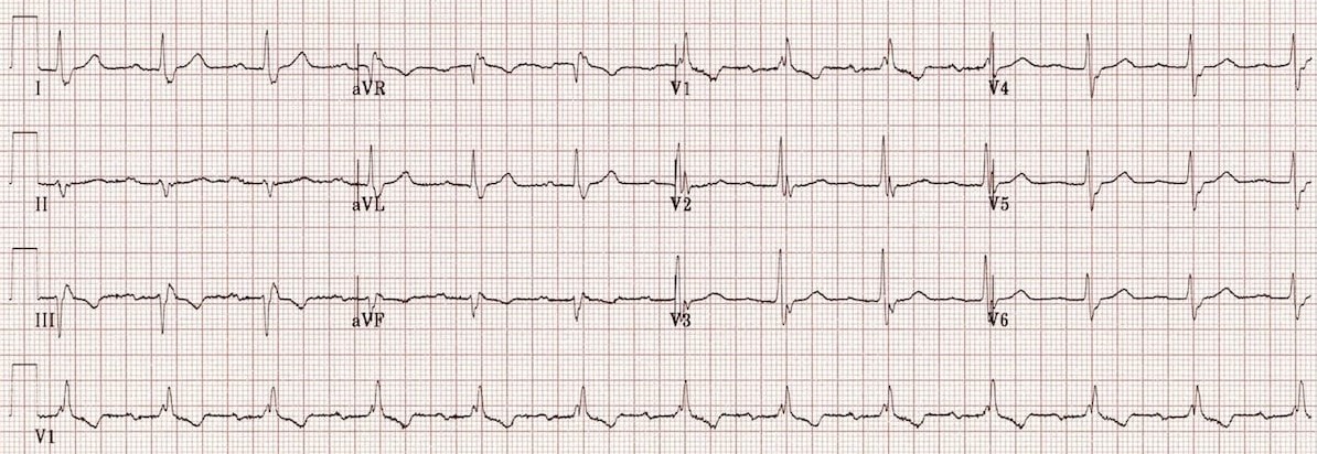 ЭКГ трехпучковой блокады