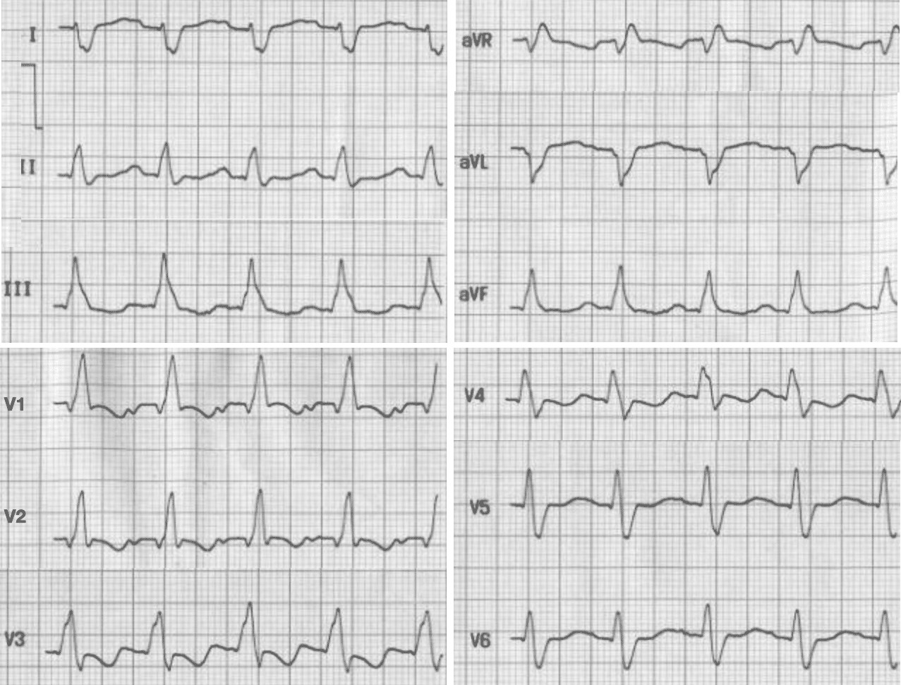 ЭКГ бифасцикулярной блокады (ПБПНГ + БЗВЛНПГ)