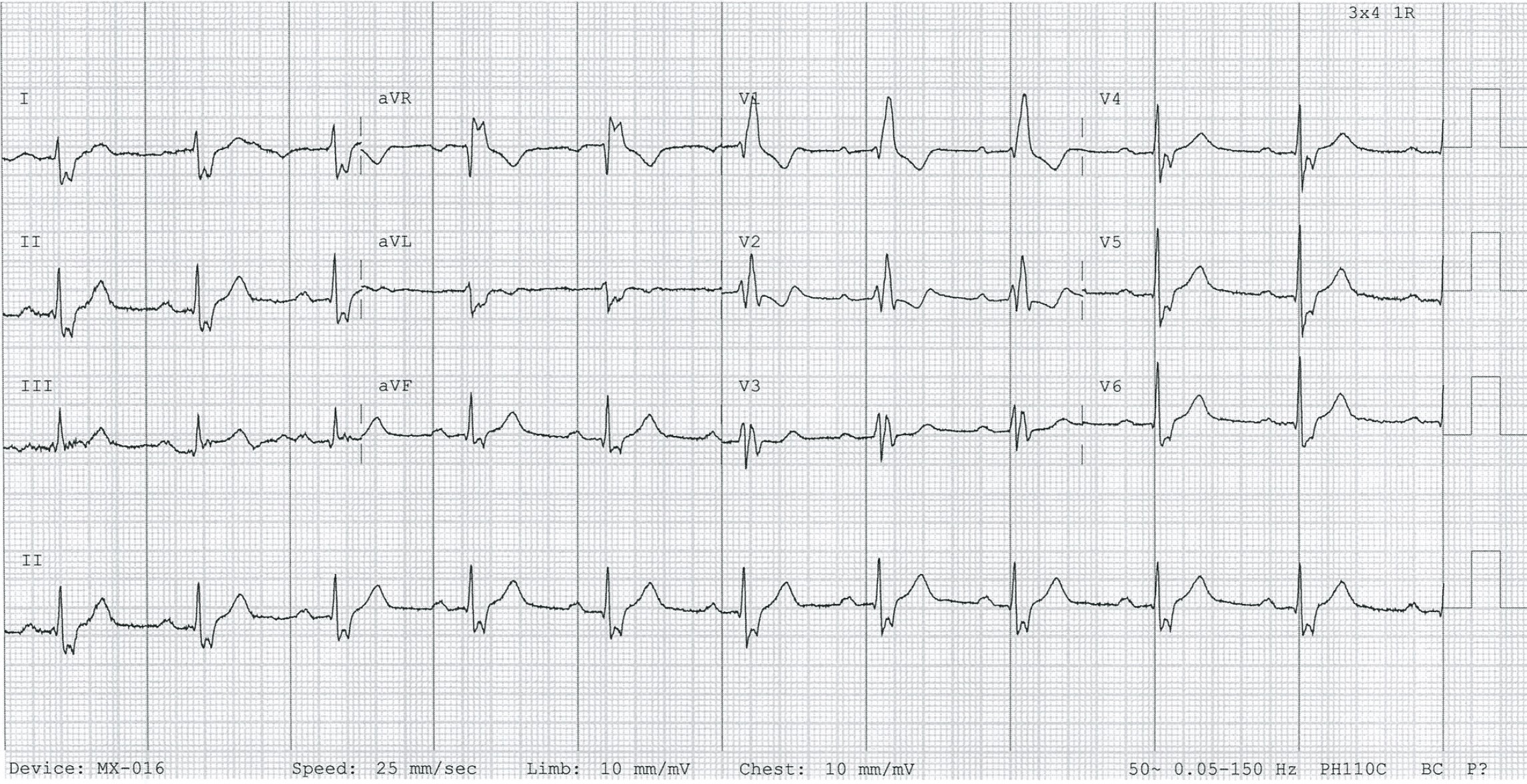 ЭКГ бифасцикулярной блокады (ПБПНГ + БЗВЛНПГ)