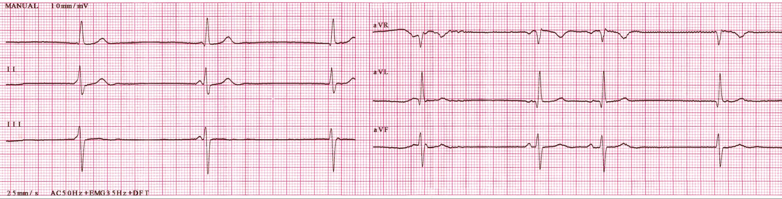 ЭКГ синдрома слабости синусового узла