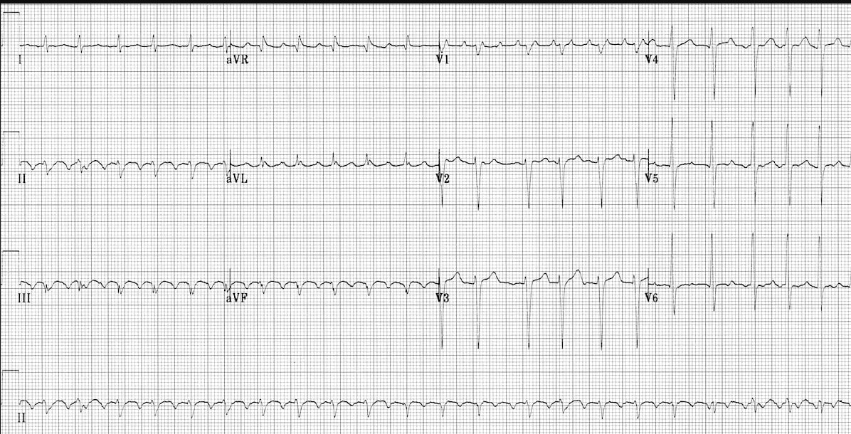 ЭКГ трепетания предсердий