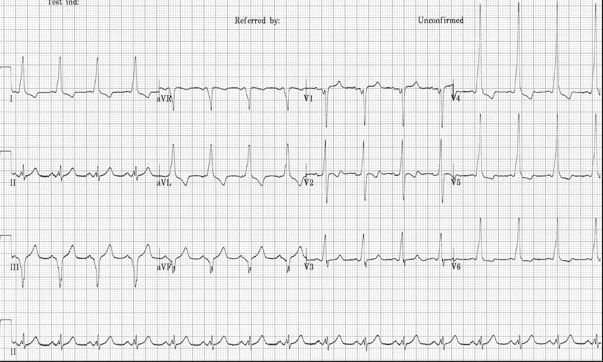 ЭКГ синдрома WPW, тип B