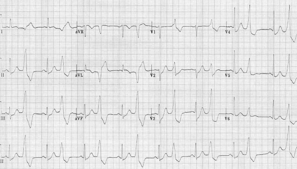 ЭКГ желудочковой экстрасистолии (бигеминия)