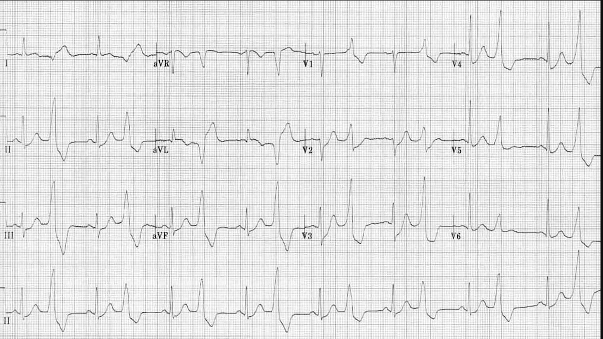 ЭКГ желудочковой экстрасистолии