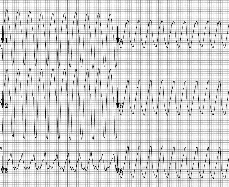 Желудочковая тахикардия